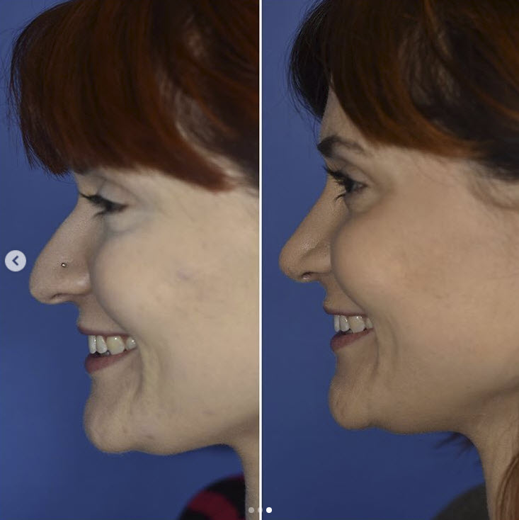 best nose plastic surgeon